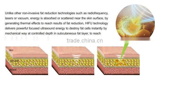 popular HIFU body slimming machine/ hifu liposonix slimming machine