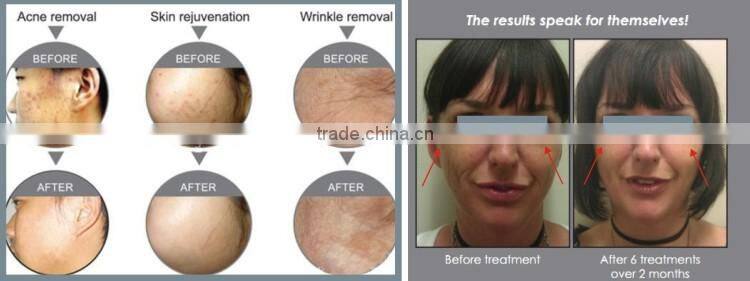 Photon skin rejuvenation pdt led light therapy machine