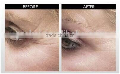 180 Eye Wrinkles Needle Roller Acne Scars Cellulite Stretch Mark Face Body Derma