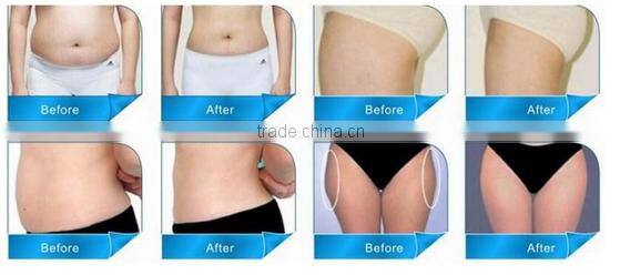 2016 Newest Wight Loss Machine Ultrashape Body Slimming Machine