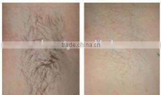 666 Newest beauty salon use folding screen hair removal 808nm Diode Laser machine,diode laser - A009