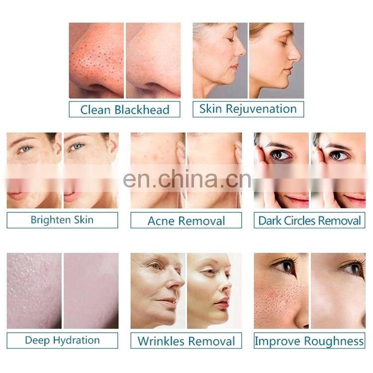 6 in 1 Small bubble microdermabrasion facial deep cleaning machine with ultrasonic rf scrubber