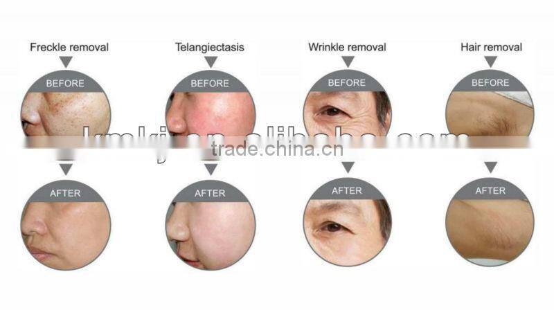 Strong power elight machine for hair removal