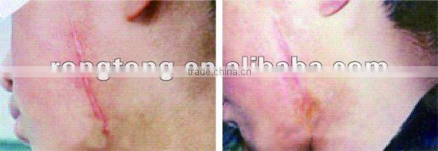 2015 NEW CO2 beauty equipment used beauty salon equipment for sale facial laser treatment