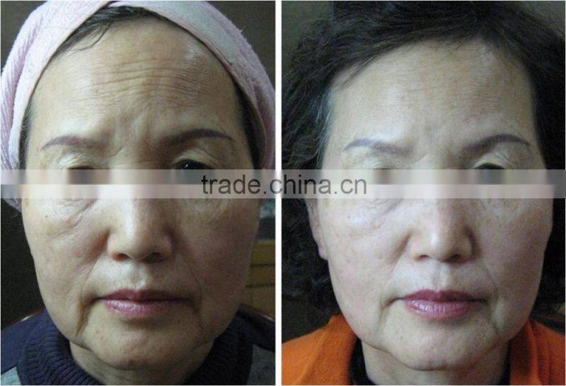 Factory direct selling Low price RF machine skin tightening face lifting ZOEY