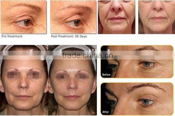 Beauty machine face lifting portable hifu / hifu for wrinkle removal system