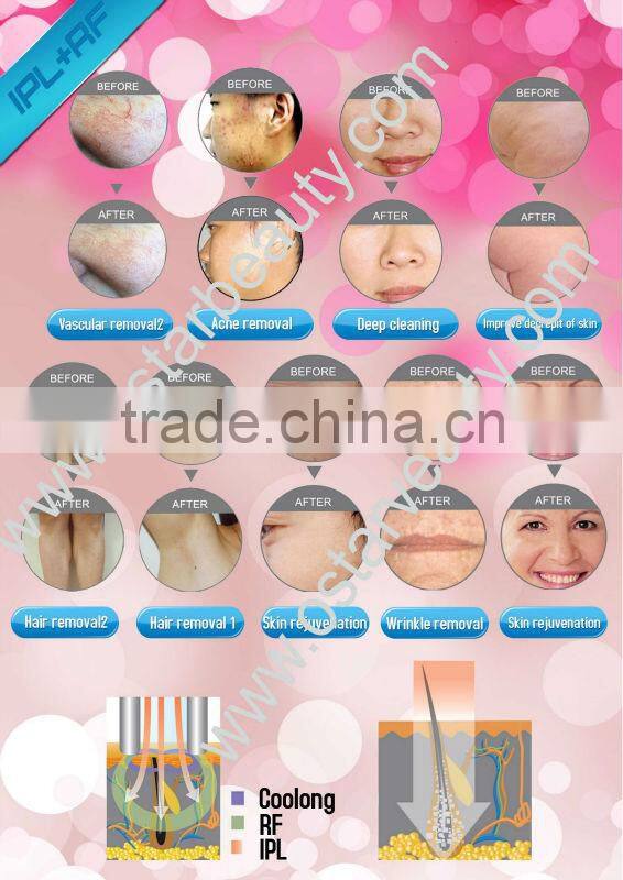 2015 HOT mini rf home use wrinkle removal machine OB-R03