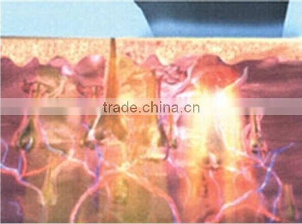 2016 most hot sale super hair removal ipl shr / shr ipl depilation / shr hair removal machine for sale