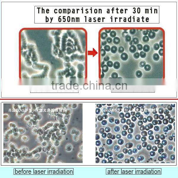 China factory dropship retail physical therapy healthy laser watch lower blood cholesterol