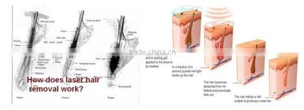 Diode laser dark skin hair removal! long pulse nd yag laser hair removal