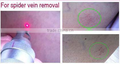 Nd yag long pulse spider veins/hair removal laser machine/Depilator (FB-P001)