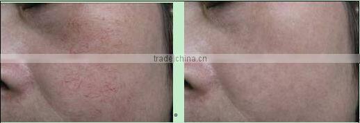 Laser /e-light/High frequency/ ipl vascular lesions removal