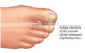 Long pulse nd yag laser nail fungus/ Onychomycosis removal machine