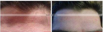 Professional derma roller for stretch marks 2.5mm