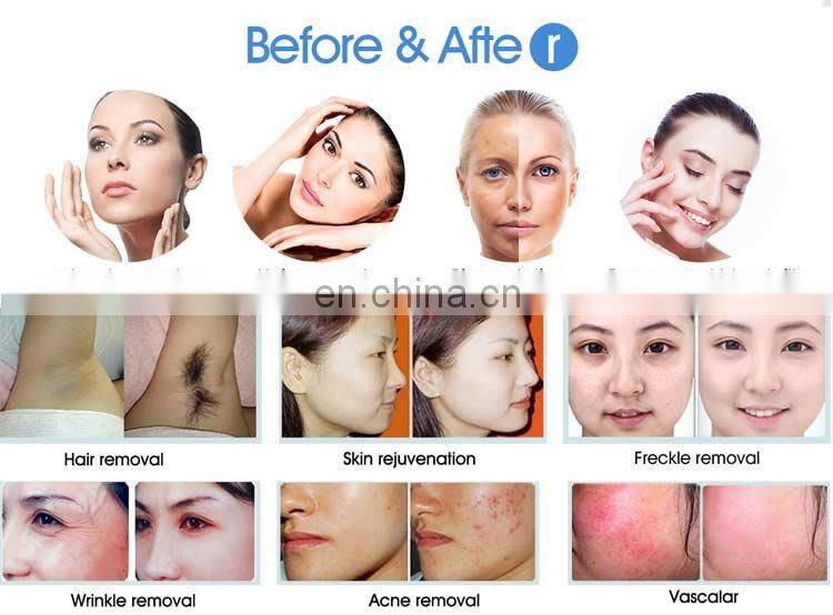 Elight / ipl pigmantion home use ipl portable hair removal