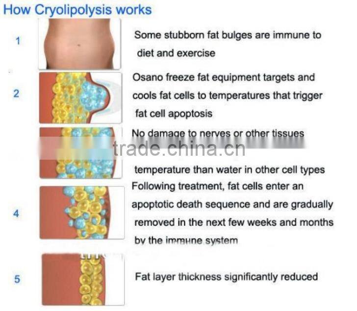 Cryolipolyse fat freezing,cryolipolyse cavitation rf,cryolipolyse fat freezing machine