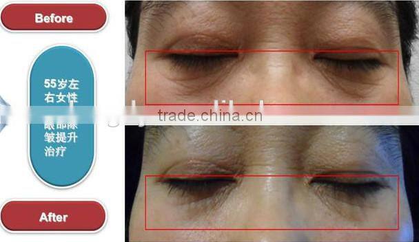 2015 newest high intensity focused ultrasound hifu/ face lifting/anti-aging/ wrinkle removal