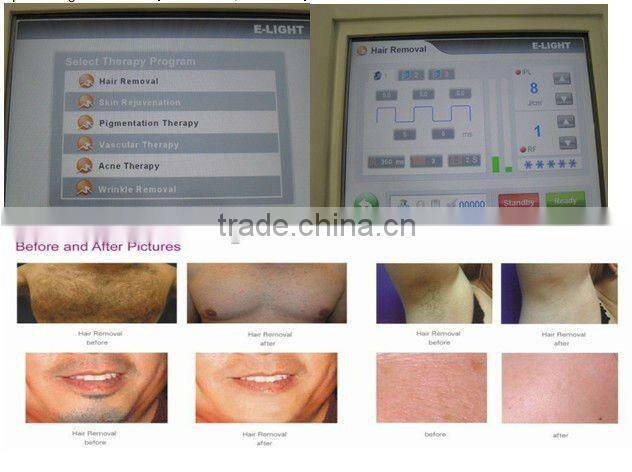 hair scanner IPL beauty machine
