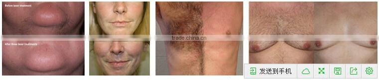 Factory price portable elight ipl rf IPL SHR&E-light hair removal equipment&machine price