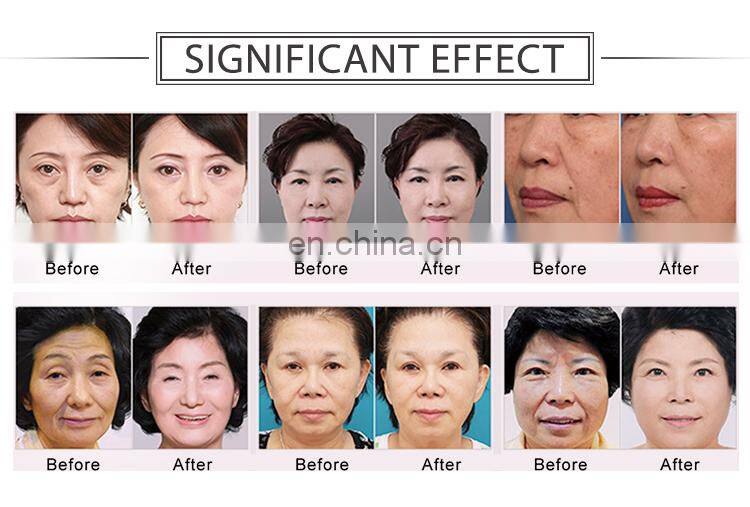 RF system skin beauty machine