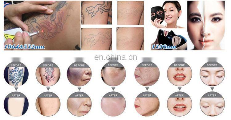 multifunctional q switched nd yag laser tattoo removal machine for beauty salon equipment