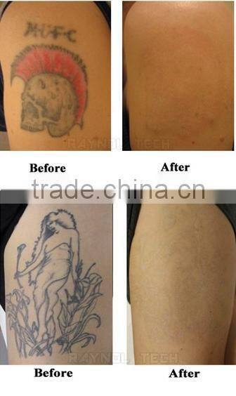 Best Price of Portable 1064/532nm Q Switched Nd:YAG Laser Tattoo Removal / laser tattoo remover / tattoo laser