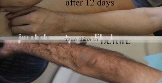 Fast permanent hair removal machine 808nm diode laser