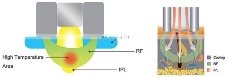 HOT cheap Elight hair removal machine ipl & rf