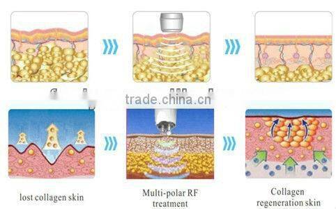 Vacuum tripolar rf cavitation machine