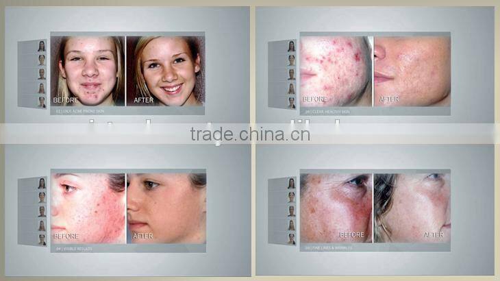 Portable hydra microdermabrasion facial beauty machine with water jet peel