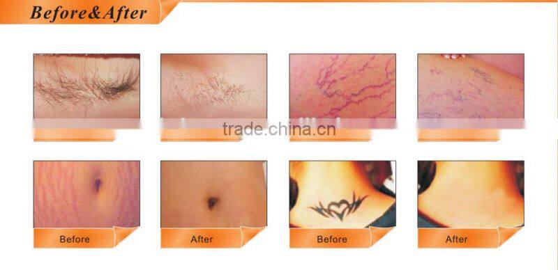 Face life Powerful Radio Frequency ND yag laser machine