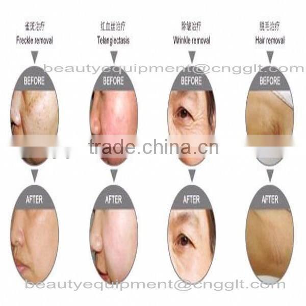 IPL+RF Hair Removal no 1mw red laser diode module