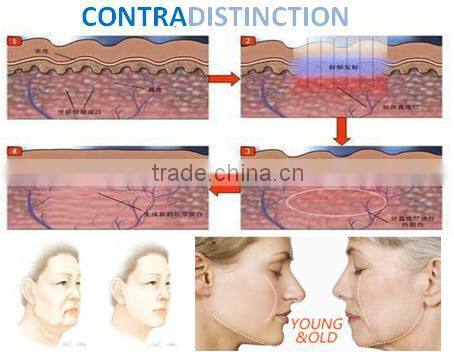 Best no needle cooling RF skin beauty machine for home use