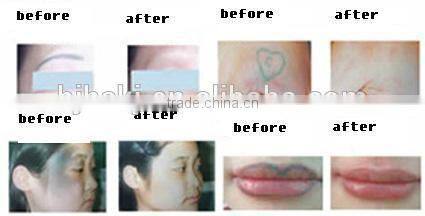 2015 pianess safe lase operation system and skin scrubber type yag laser