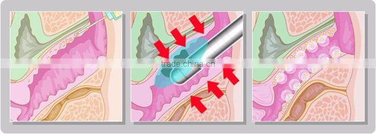 2016 new product Portable Hifu skin care vaginal tightening Sexy beauty machine