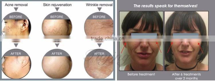 7 lights led pdt led infrared light facial machine PDT beauty salon machine