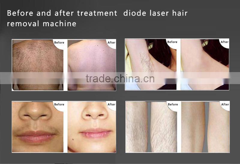 808nm diode laser epilator for salons with medical CE certificate