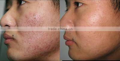 skin rejuvenation elight/ at home skin tightening machine C005