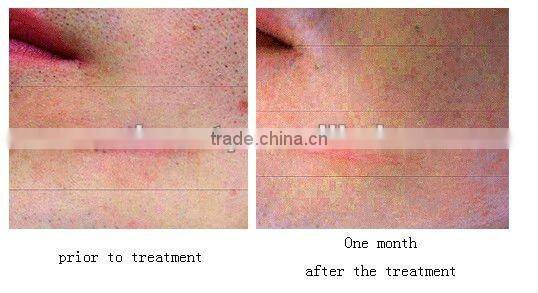 Titanium Led Deramroller Derma Roller --L011