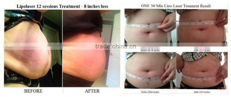 Home use lipolaser slimming best lipo laser machine