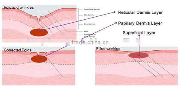 2015 popular most powerful! anti-wrinkle microneedles fractional rf micro needles machine
