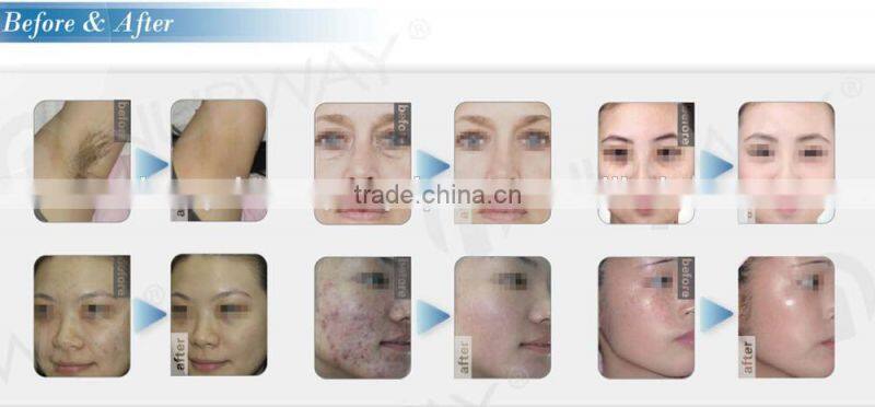 2015 ipl/rf multifunction beauty facial machine hair removal