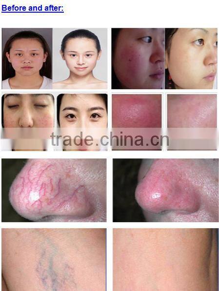 Diode Laser 980nm Vascular Remove/ Vein Wave Machine/ Spider Vein Removal