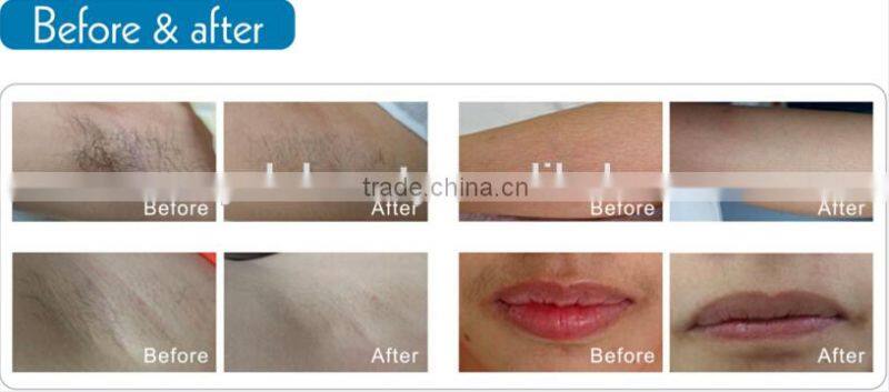 2016 YALO Hair Removal Machine for woman use