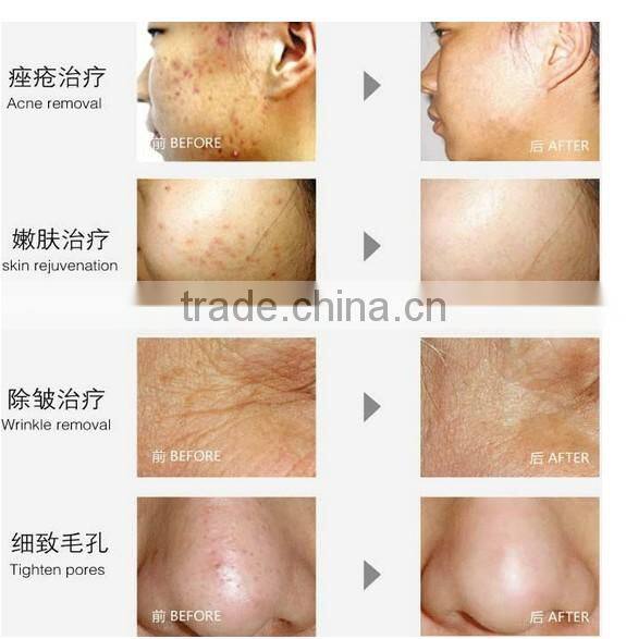 2014 new product pdt skin care system/pdt machine