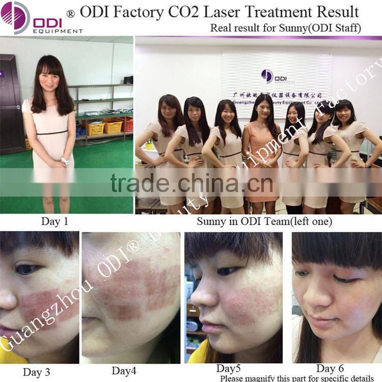 World best selling fractional co2 stretchmark and scar removal laser machine