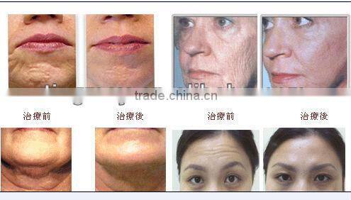 TM-097 high frequency electric hair follicle stimulator