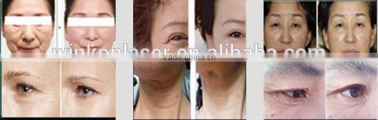 Non-surgical face lifting thermagic equipment