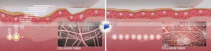 CE Certificated 2 in 1 hifu for face Wrinkle Remover female hifu vaginal tightening machine