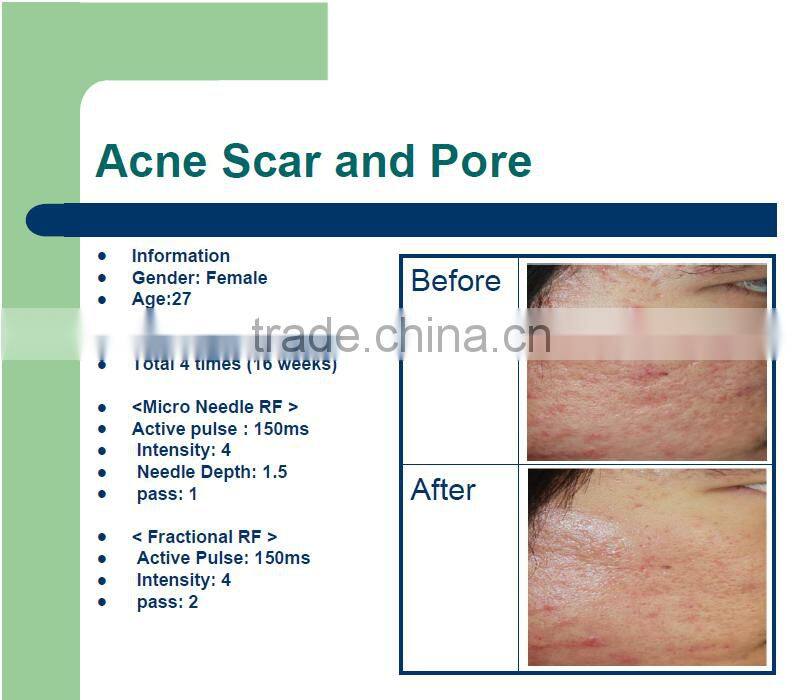 New arrival oem skin whitening pinxel microneedle fractional radio frequency